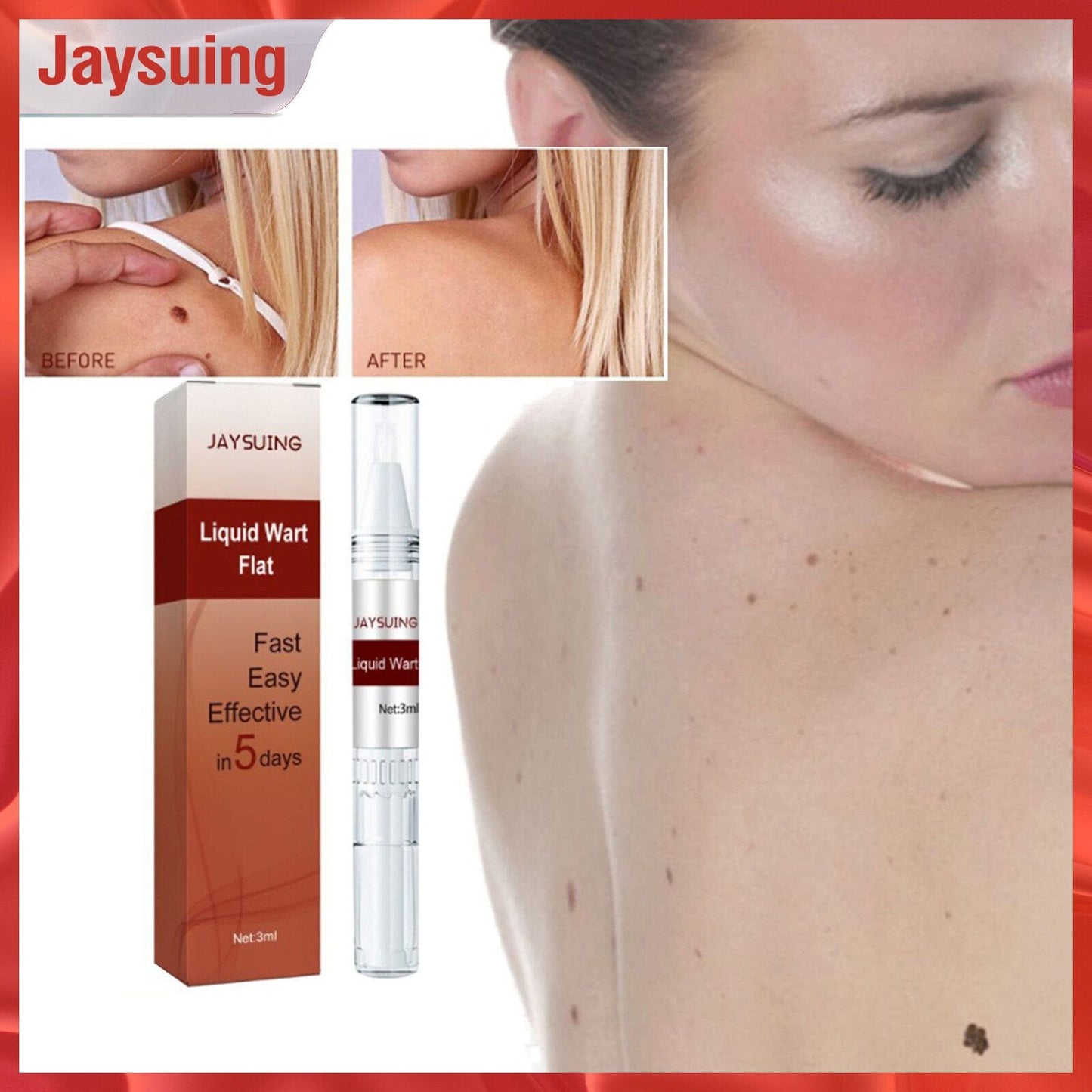 Professional Skin Tag & Mole Removal Device – Flawless Skin At Home - Vistora